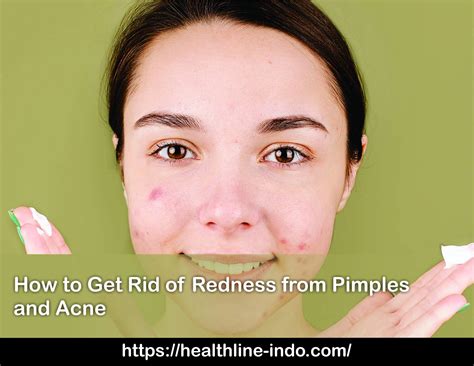 How To Get Rid Of Redness From Pimples And Acne Healthline Indonesia