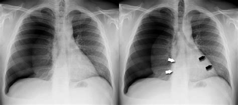 Chest X Ray Pneumothorax Gallery Large Pneumothorax Early Tension