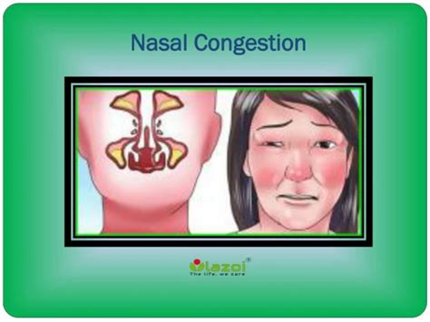 Ppt Symptoms Causes And Treatments Guide For Nasal Congestion