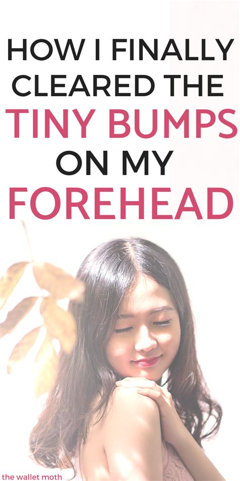 How I Cleared My Tiny Bumps On Forehead Once And For All Skin Care