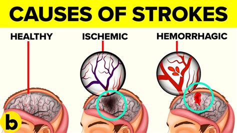 17 Causes Of A Stroke That Will Surprise You Youtube
