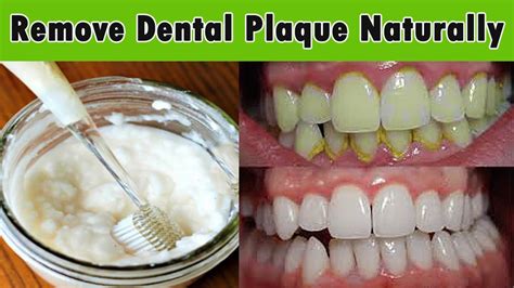 this mouthwash removes plaque from teeth in 2 minutes healhty and tips