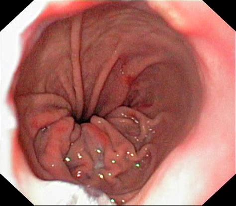 Hiatal Hernia And Barretts Oesophagus Photograph By Gastrolabscience