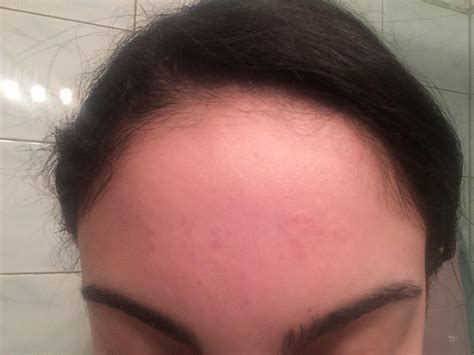 Small Raised Bumps On Forehead Pictures Photos Images And Photos Finder
