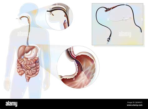 Gastroscopy Route And Location Of The Gastro Fiberscope Introduced