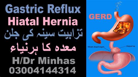 Acid Reflux Gerd Hiatal Hernia Causes Symptoms Hdr Minhas تزابیت جلن