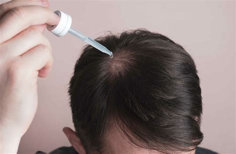 Can Topical Finasteride Regrow Hair Myhair