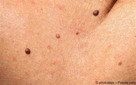 Melanoma treatment options include surgery, chemotherapy, radiation therapy, immunotherapy, and targeted therapy. Das Maligne Melanom Derzeitiger Stand In Diagnose Und ...