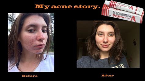 Tretinoin Cream Before And After Acne Scars Wererabbits