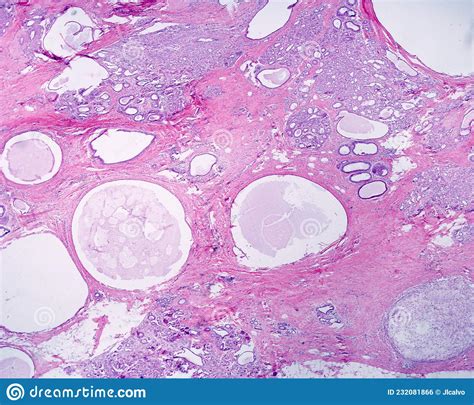 Fibrocystic Breast Disease Stock Photo Image Of Tdlu 232081866