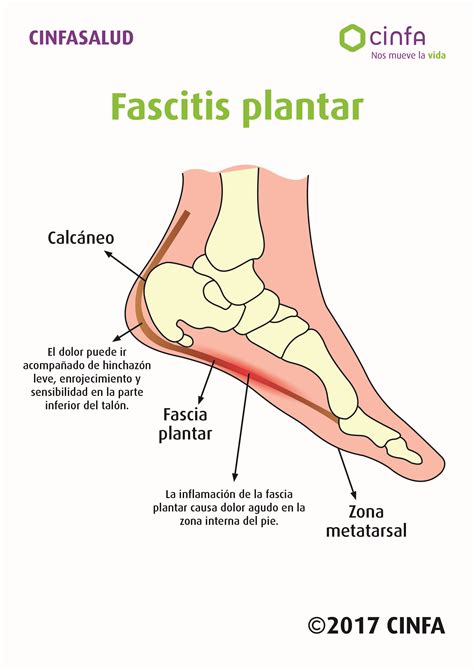 Plantar Fasciitis Causes Symptoms And Treatment Options Artofit