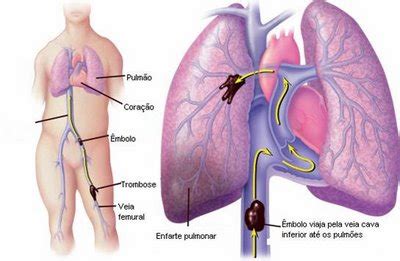 Blog Dr Carlos Embolia Pulmonar