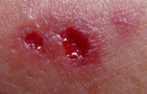 Wolf Spider Bite What You Need To Do