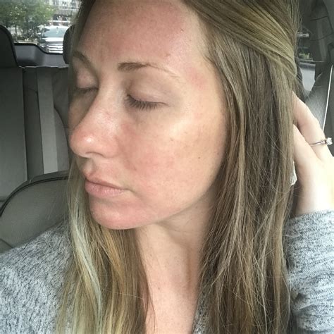 My First Ipl Microneedling Experience With Jazzi Cosmetics Weekend