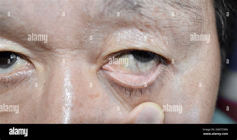 Pale Skin Of Asian Elderly Man Sign Of Anemia Pallor At Eyelid