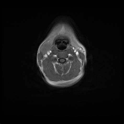 Second Branchial Cleft Cyst Image