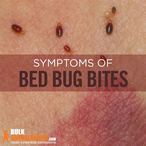 Bed Bug Bites On African Americans