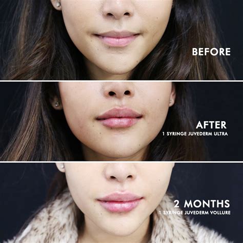 Lip Augmentation Before And After Photos Usha Rajagopal Md