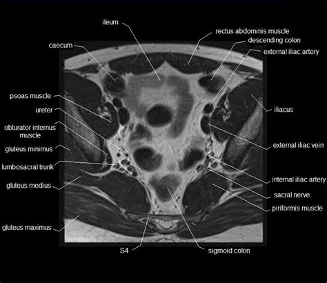 Psoas major passes in front of. MRI pelvis anatomy | free male pelvis axial anatomy