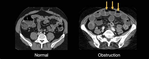 Abdominal CT Small Bowel Obstruction LITFL Radiology Library