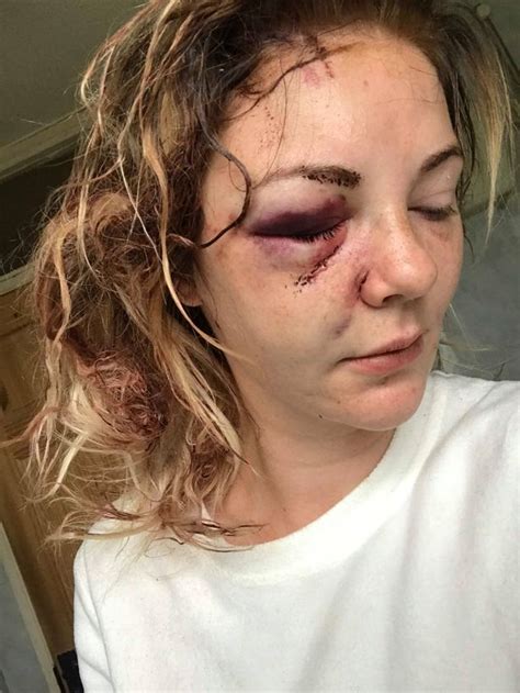Young Dublin Woman Left Battered And Bruised After Attack In Pub And On