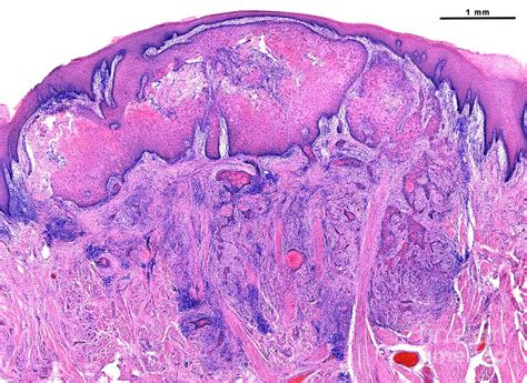 Squamous Cell Carcinoma Tongue