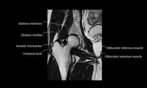 Quadriceps tendon semitendinosus tendonsemimembranosus muscle popliteal artery and vein biceps femoris femur vastus medialis sartorius muscle suprapatellar bursa. anatomy of hip joint | free MRI coronal cross sectional ...