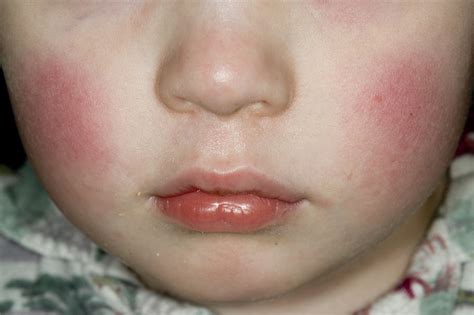 Skin Rashes In Babies Nhsuk