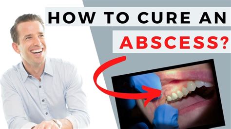 Tooth Abscess Stages Pictures