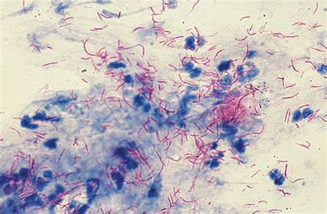 Mycobacterium Chelonae Wound Ulcer After Clear Corneacataract Surgery