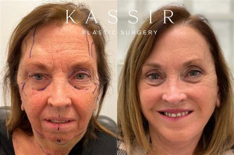 Is A Deep Plane Facelift Worth It — Kassir Plastic Surgery In Ny And Nj