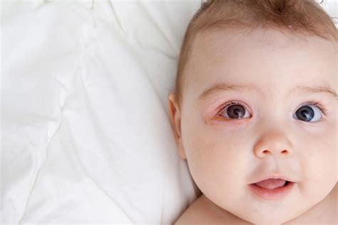 Swollen Eyes In Babies Causes Home Remedies And Treatment