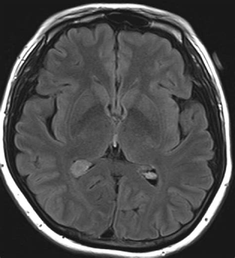 Choroid Plexus Xanthogranuloma Neuro Mr Case Studies Ctisus Ct Scanning