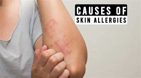 What Are The Common Causes Of Skin Allergies Go Lifestyle Wiki