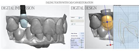 Before And After Gallery Asird American Society Of Implant And