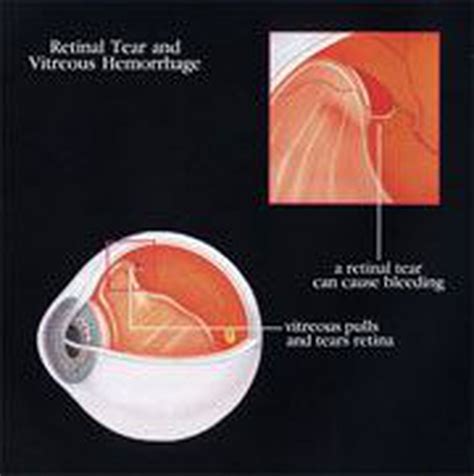 If a retinal tear is detected early, treatment can prevent the retina from detaching. Retinal Tear and Vitreous Hemorrhage