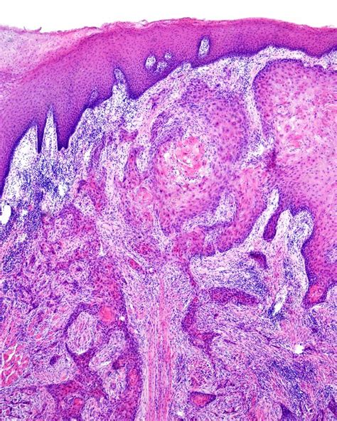 Squamous Cell Carcinoma Of The Tongue Light Micrograph Stock Image