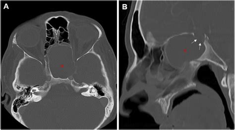 A Case Of Sphenoid Mucocele Causing Hypopituitarism Elif Gozgec