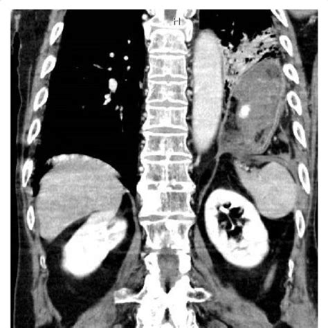 Preoperative Chest Computed Tomography Scans Showing Left Diaphragmatic