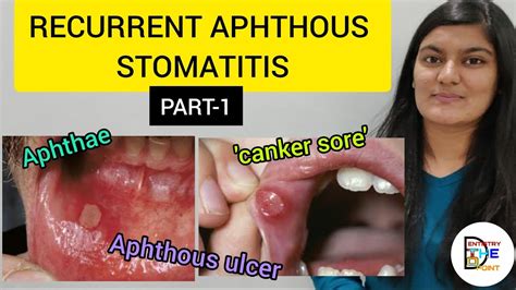 Recurrent Aphthous Stomatitis Ras Part 1 Youtube