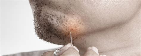 Ingrown Hair What Is It What Causes It And How To Treat It