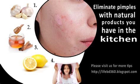 4 Healthy And Natural Ways To Get Rid Of Pimples Life In Bangladesh