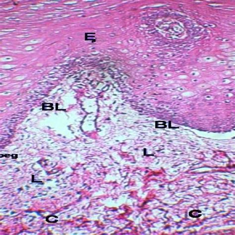 Oral Lichenoid Lesions Bl Basal Layer C Connetive Tissue E