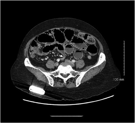 Ct Abdomen Pelvis Without Contrast Hot Sex Picture