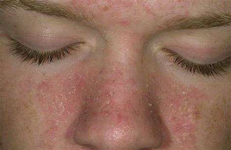 Dry Skin Dry Skin On Face Flaky Skin On Face Itchy Flaky Skin