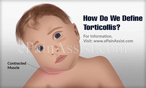 Torticollis Or Wry Neck Or Loxiacausessymptomsdiagnosistreatmentprognosis