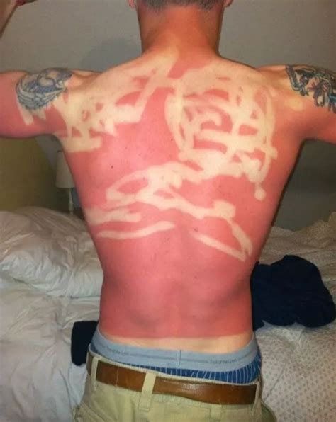 Show Us A Picture Of Your Worst Sunburn Ever Bad Sunburn Funny