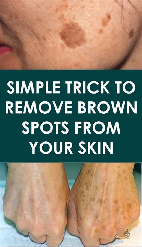 Simple Trick To Remove Brown Spots From Your Skin Health Experts