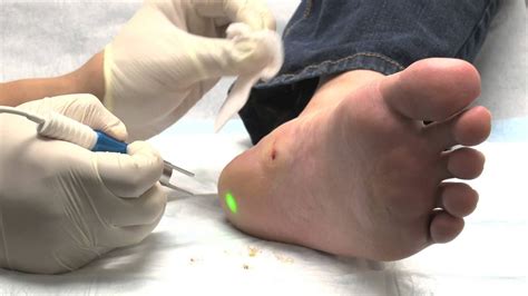 Laser Treatment For Warts Using The Fox Laser Youtube