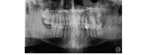 Panoramic Radiograph Showing A The Dentigerous Cyst B The Impacted